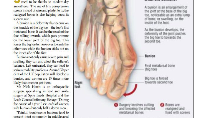 Bunion surgery –  “I feel as though I have been given a new foot”