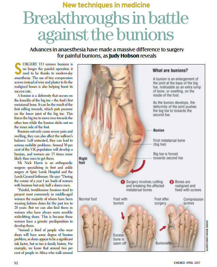 Bunion surgery –  “I feel as though I have been given a new foot”