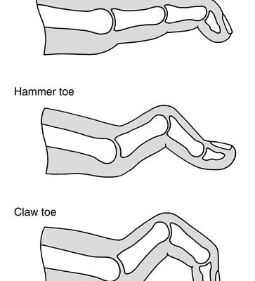 Toe Deformities – Mallet, Hammer, Claw and Overlapping 5th Toe